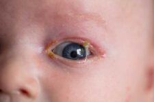 Why Do Newborn Eye Keeps Getting Crusty?
